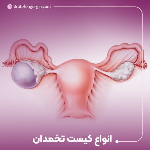 انواع کیست‌ تخمدان