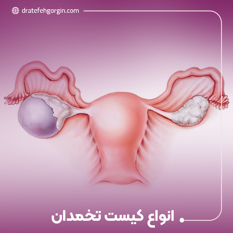انواع کیست‌ تخمدان