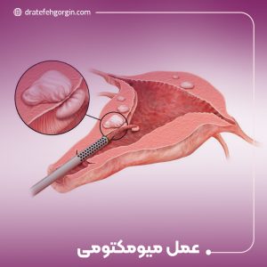 عمل میومکتومی
