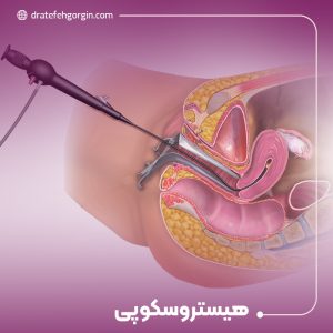 هیستروسکوپی چیست؟