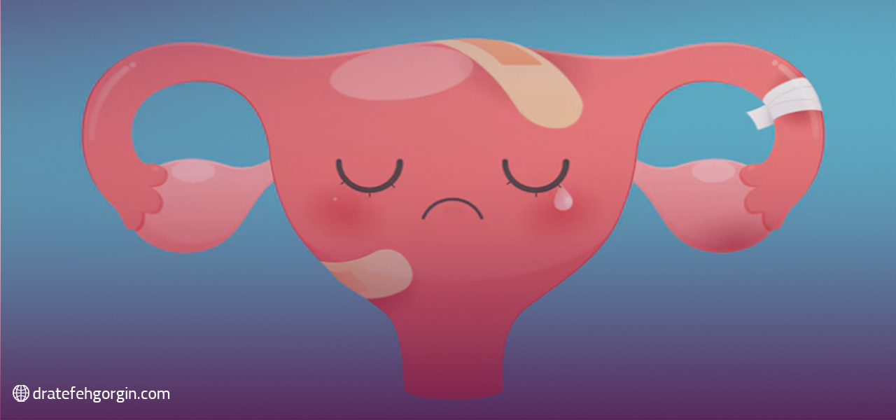 بررسی علل آندومتریوز و علائم آن