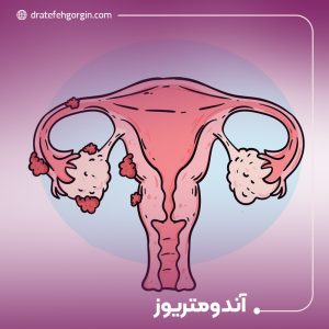 آندومتریوز چیست؟