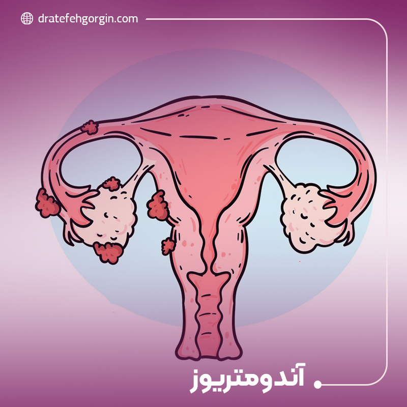 آندومتریوز چیست؟