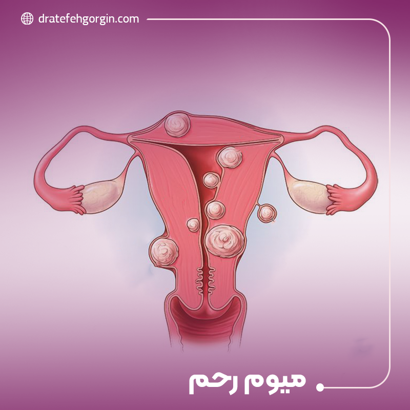 میوم رحم