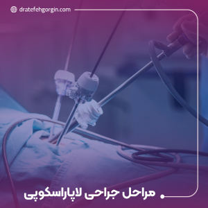 مراحل جراحی لاپاراسکوپی