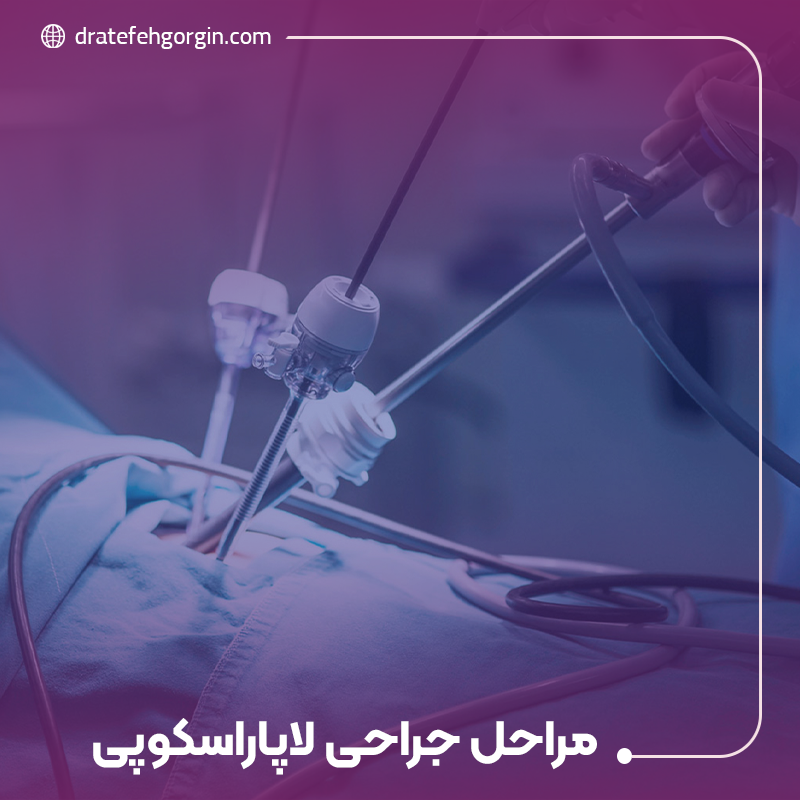 مراحل جراحی لاپاراسکوپی