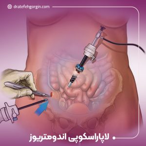 لاپاراسکوپی اندومتریوز، تشخیص دقیق و گزینه‌های درمان کم تهاجمی