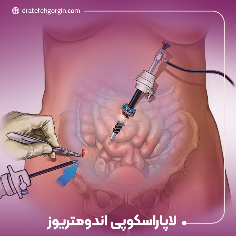 لاپاراسکوپی اندومتریوز، تشخیص دقیق و گزینه‌های درمان کم تهاجمی