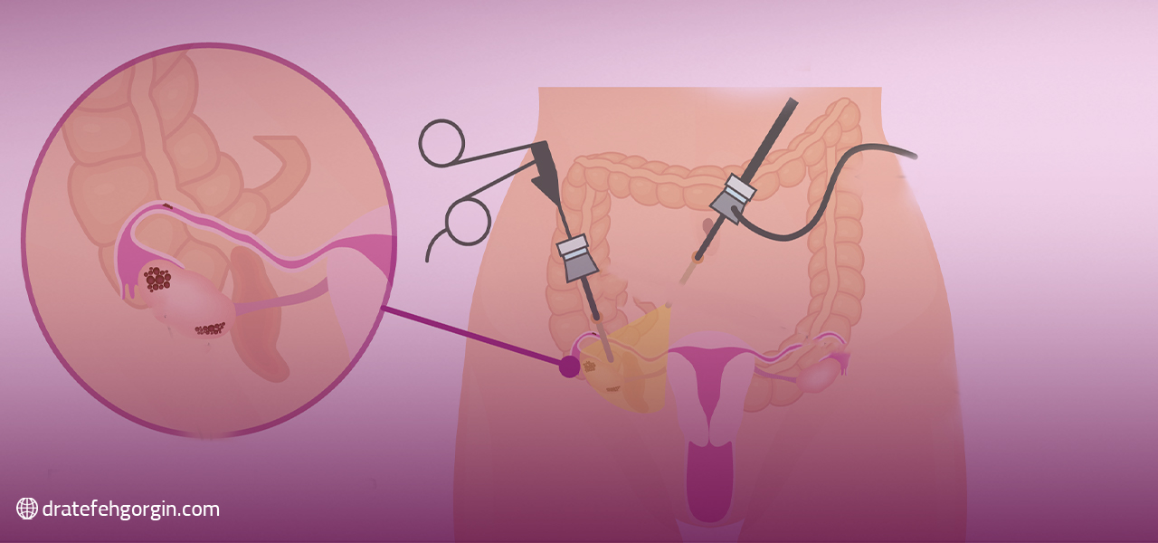 لاپاراسکوپی اندومتریوز چگونه انجام می شود؟