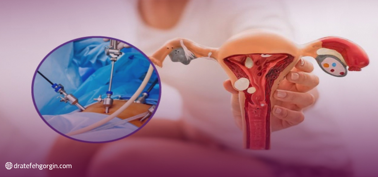 هدف از لاپاراسکوپی آندومتریوز چیست؟
