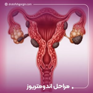 مراحل اندومتریوز