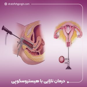 درمان نازایی با هیستروسکوپی